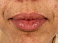 Hyperpigmentatie Minocin