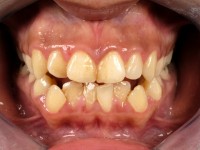 Hyperpigmentatie Minocin