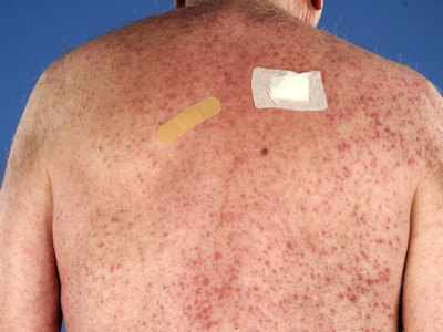 Mitomycin C induced generalized pustular eruption