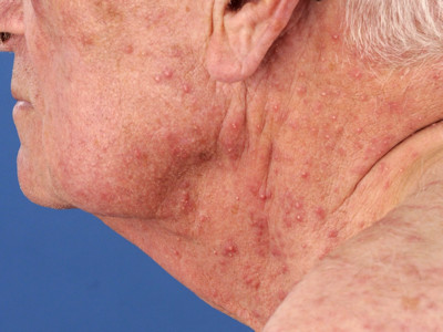 Mitomycin C induced generalized pustular eruption