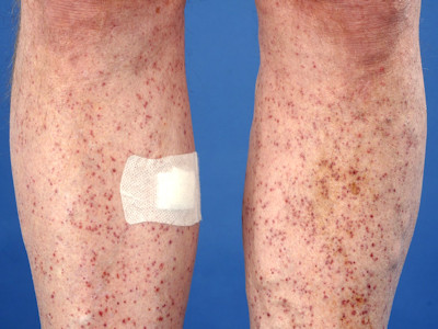 Mitomycin C induced generalized pustular eruption