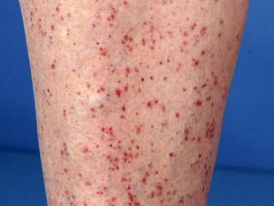 Mitomycin C induced generalized pustular eruption