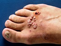 Mollusca contagiosa bij HIV