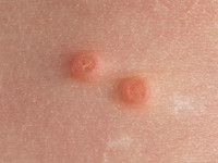 Mollusca contagiosa