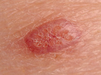 Mollusca contagiosa