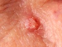 Mollusca contagiosa