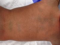 Mongolenvlek,  Mongolian spot