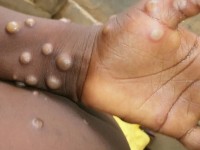 Monkeypox (apenpokken)
