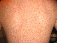 Mononucleosis infectiosa