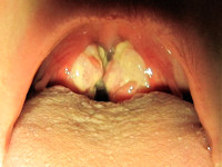 Mononucleosis infectiosa