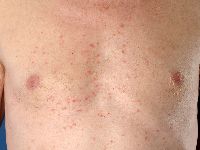 M. Grover (transient acantholytic dermatosis)