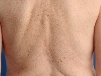 M. Grover (transient acantholytic dermatosis)