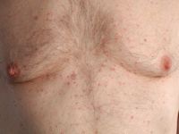 M. Grover (transient acantholytic dermatosis)