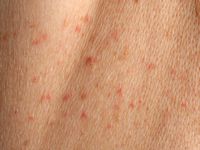 M. Grover (transient acantholytic dermatosis)