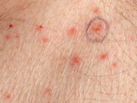 M. Grover (transient acantholytic dermatosis)