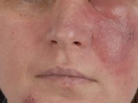Morbus Morbihan (faciaal lymfoedeem in het kader van rosacea)
