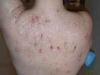 Morgellons disease: pluisjes op de huid (en jeuk)
