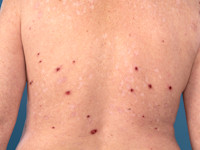 Morgellons disease: pluisjes op de huid (en jeuk)