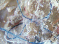 Morgellon disease: pluisjes op de huid (en jeuk)