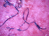 Morgellons disease: pluisjes op de huid (en jeuk)