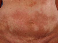 Morphea