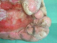 Mossy feet bij lymfoedeem en veneuze insufficientie