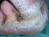 Mossy feet bij lymfoedeem en veneuze insufficientie