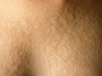 Mucinosis follicularis