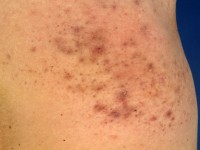 Mucinosis follicularis