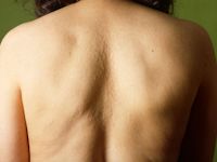 Mucinosis follicularis