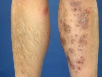 Mucinosis follicularis