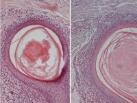 Mucinosis follicularis
