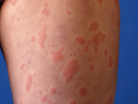 Muckle-Wells syndroom