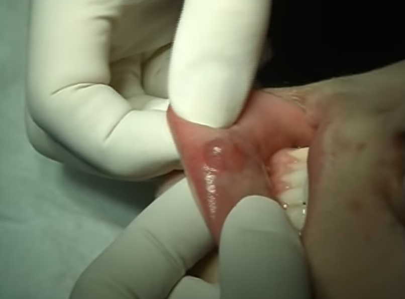 Video: chirurgische excisie van een mucocèle op de onderlip