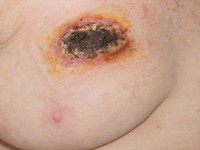 Cutane mucormycosis