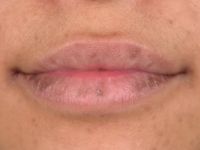 Mucosale lentiginosis