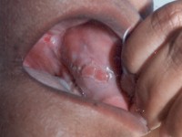 Mucous membrane plasmacytosis