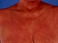 Multicentrische reticuliohistiocytose