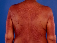 Multicentrische reticuliohistiocytose