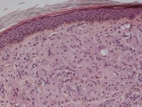Multicentrische reticulohistiocytose