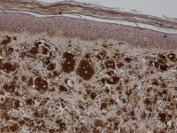 Multicentrische reticulohistiocytose