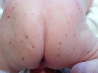 Multifocal lymphangioendotheliomatosis with thrombocytopenia (MLT)