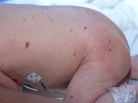 Multifocal lymphangioendotheliomatosis with thrombocytopenia (MLT)