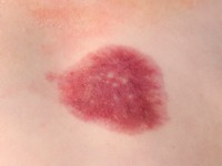 Multifocal lymphangioendotheliomatosis with thrombocytopenia (MLT)