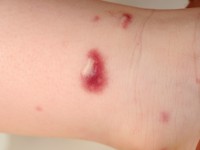 Multifocal lymphangioendotheliomatosis with thrombocytopenia (MLT)