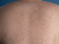 Multipele eruptieve collagenomen