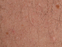 Multipele eruptieve collagenomen