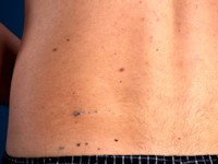 Multipele glomangiomen