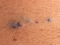 Multipele glomangiomen