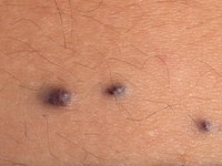 Multipele glomangiomen